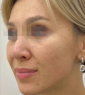 Микроигольчатый рф лифтинг - фото після