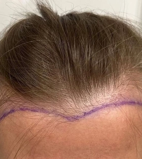 Пересадка волос 1800 графт - фото до