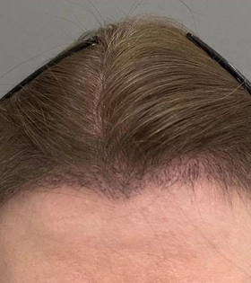 Пересадка волос 1800 графт - фото після