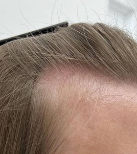 Пересадка волос - фото до