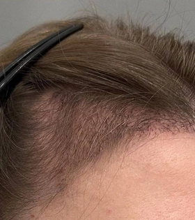 Пересадка волос - фото після