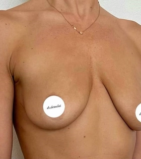 Подтяжка груди - фото до