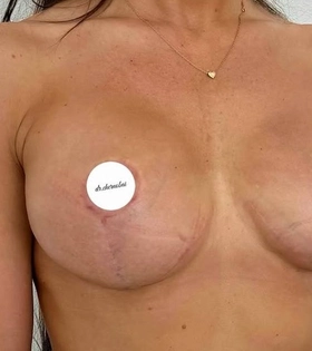 Подтяжка груди - фото після