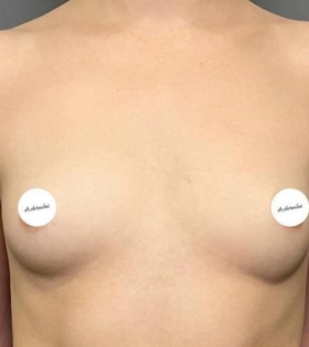 Увеличение груди_до_Чернобай - фото до