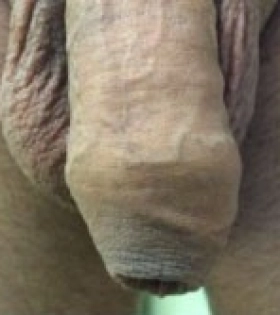 Обрізання (циркумцизіо) - фото до