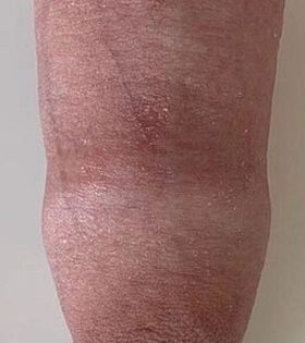 Обрізання (циркумцизіо) - фото до