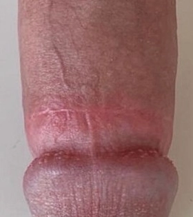 Обрізання (циркумцизіо) - фото після