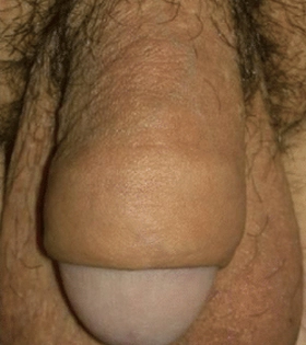 Обрізання (циркумцизіо) - фото після