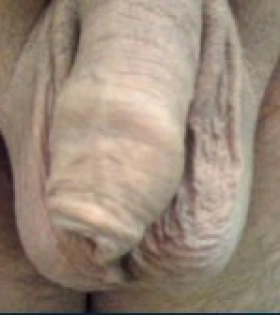 Обрізання (циркумцизіо) - фото до