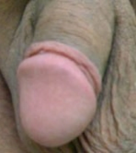 Обрізання (циркумцизіо) - фото після