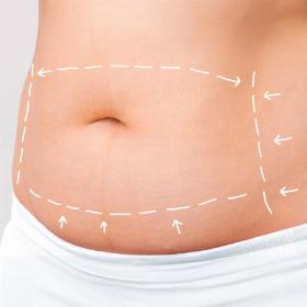 Абдомінопластика 