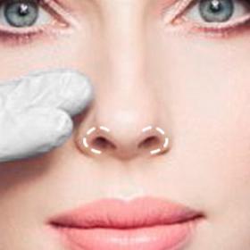 Ринопластика ніздрів 
